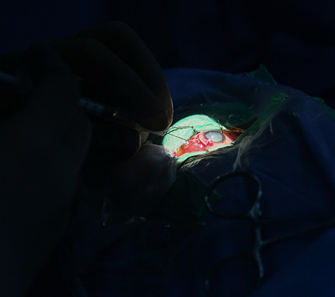 Cirugía de cataratas en Bogotá, persona sometida a operación