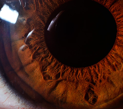 Cirugía de córnea en Bogotá, ojo de una persona